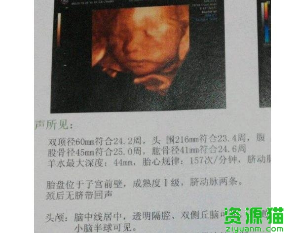 b超单子看胎儿识别准确度多少（想要辨别胎宝宝性别）(2)